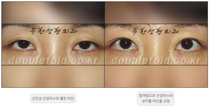 [Ptosis, Duhan Plastic Surgery] - [Sleepy-Looking Eyes, Ptosis Eye Correction] image 16