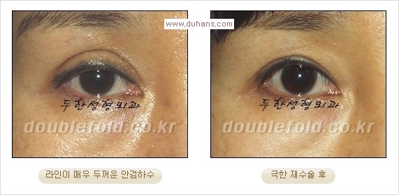 [두한성형외과 경쟁력 쌍꺼풀 재수술] - [피부 여유분이 부족해서 토안증이 발생한 경우 극한 재수술] 관련 이미지 3