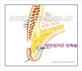 [두한성형외과 경쟁력 눈성형] - [쌍꺼풀 재수술 실패의 원인과 문제점] 관련 이미지 8