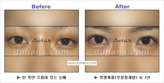 ​[두한성형외과 경쟁력 눈성형] - [자연스럽고 아름다운 쌍꺼풀의 기준] 관련 이미지 22
