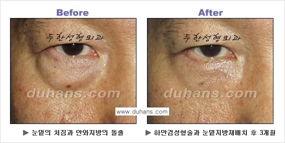 [두한성형외과의 상큼하고 환한 젊은 눈매완성] - [하안검 성형술 ①] 관련 이미지 7