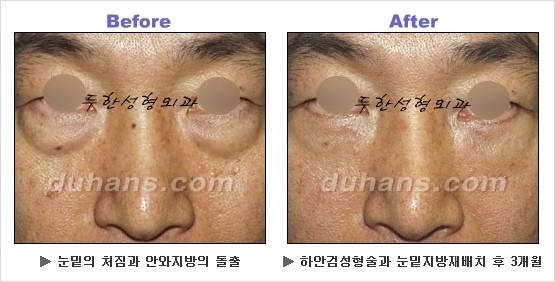 [두한성형외과 경쟁력 동안성형 리더] - ​[미간주름, 이마주름, 안검성형, 이마거상술, 눈썹거상술] 관련 이미지 86