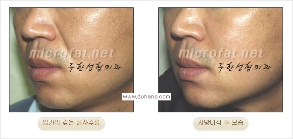 [두한성형외과 경쟁력 주름성형] - [주름 교정을 위한 안전하고 효과적인 미세지방이식] 관련 이미지 9