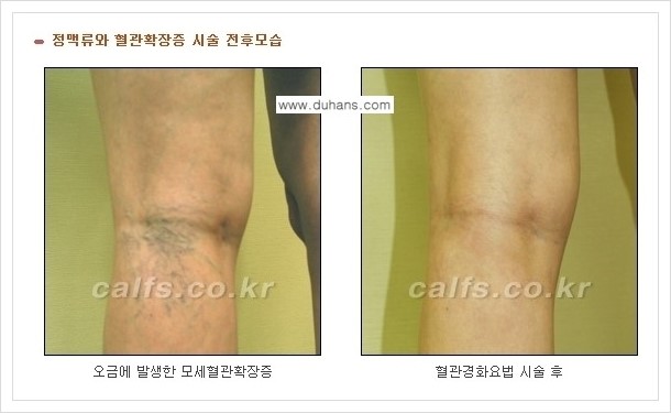 [두한성형외과 경쟁력 멀티종아리성형] - [나에게 맞는 종아리성형 방법의 종류 안내 3.] 관련 이미지 11