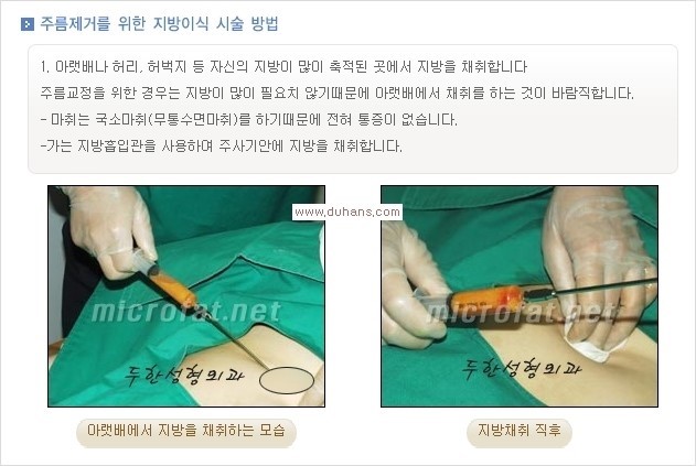 [두한성형외과 경쟁력 주름성형] - [입가와 팔자의 주름제거 지방이식 1.] 관련 이미지 3