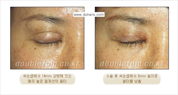 [두한성형외과] - [쌍꺼풀 재수술에서 매우높은 흉터선의 처리 문제] 관련 이미지 2