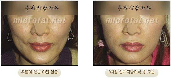 얼굴지방이식 두한성형외과 - 볼지방이식 관련 이미지 12