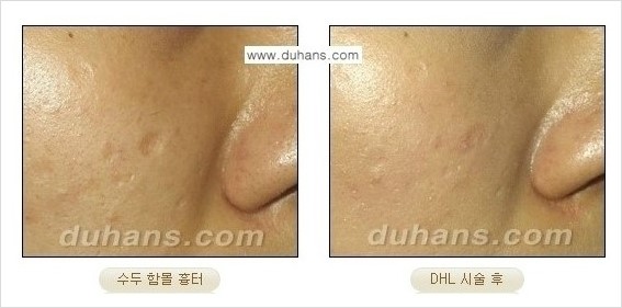 ​[두한성형외과 경쟁력 흉터성형] - [함몰흉터의 DHC 시술] 관련 이미지 1