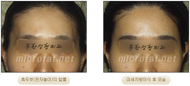 [두한성형외과 얼굴지방이식] - [측두부, 관자놀이] 관련 이미지 10