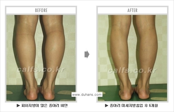 [두한성형외과 매력적인 종아리 만들기!] - [정교한 흡입 - 미세흡입관 지방흡입술 3.] 관련 이미지 13
