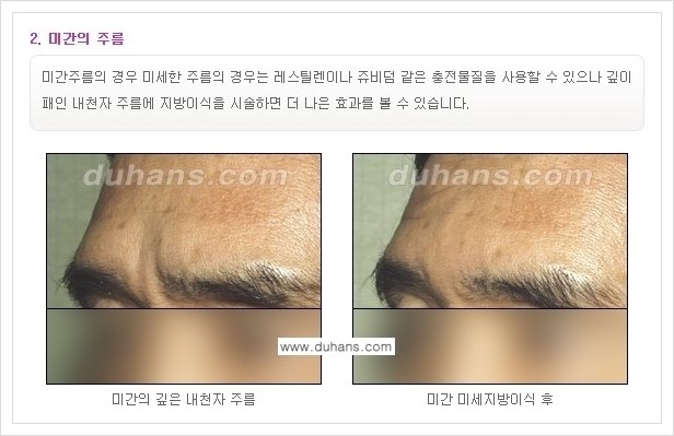 ​[두한성형외과 경쟁력 주름성형] - [주름교정을 위한 미세지방이식 안내 1.] 관련 이미지 14