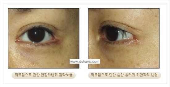 ​[두한성형외과 경쟁력 눈매성형] - [눈의 가로길이를 키우는 앞트임, 뒤트임 수술] 관련 이미지 25
