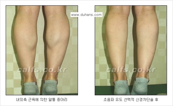 ​[두한성형외과와 날씬한 종아리 만들기!] - [간편하고 안전한 종아리 축소방법 ③] 관련 이미지 10
