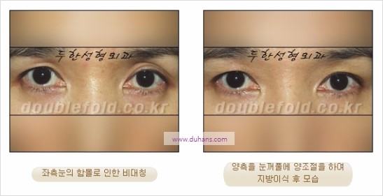 [두한성형외과 경쟁력 눈성형] - [비대칭 쌍꺼풀 라인의 여러 가지 교정 방법] 관련 이미지 18