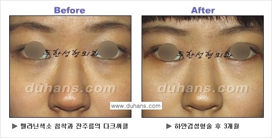 [두한성형외과의 상큼하고 환한 젊은 눈매완성] - [하안검 성형술 ②] 관련 이미지 23