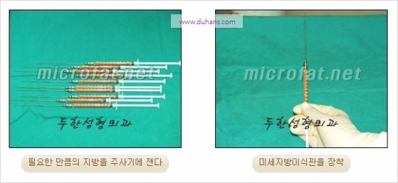 [두한성형외과 경쟁력 윤곽성형] - [볼, 볼살 지방이식] 관련 이미지 10