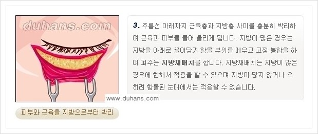 [두한성형외과 경쟁력 안검성형] - [젊은 눈매 하안검 성형술 안내] 관련 이미지 5