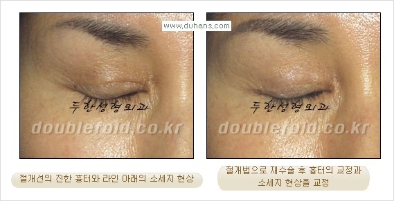 [두한성형외과 경쟁력 쌍꺼풀 재수술] - [쌍꺼풀 절개법 수술 후 쌍꺼풀 흉터선 교정] 관련 이미지 8
