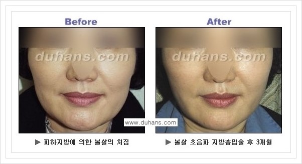 ​​[두한성형외과 경쟁력 지방흡입] - [아름다운 얼굴 윤곽선을 위한  볼살지방흡입, 턱선지방흡입 안내] 관련 이미지 14