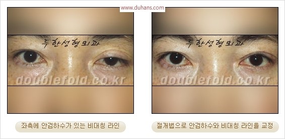 [두한성형외과 경쟁력 눈성형] - [극한 재수술, 함몰된 눈꺼풀 라인교정, 안검하수(졸리운 눈매)] 관련 이미지 97