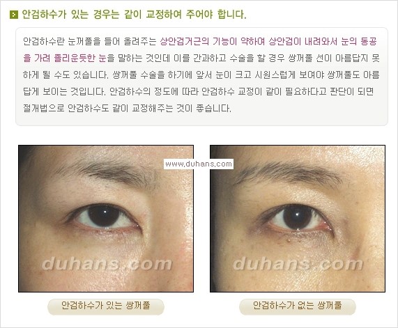 [두한성형외과 경쟁력 눈성형] - [눈성형, 쌍꺼풀 수술 방법에 관한 자주하는 질문과 답변 안내] 관련 이미지 6