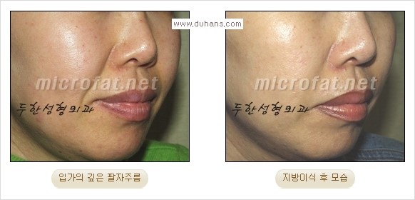 [두한성형외과 경쟁력 주름성형] - [코 옆과 입가에 걸쳐서 형성된 주름을 교정해주는 미세지방이식] 관련 이미지 8