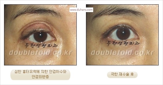 [두한성형외과 경쟁력 쌍꺼풀 재수술 스페셜] - [망가진 라인을 교정하는 극한 재수술] 관련 이미지 9