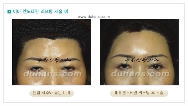 [두한성형외과 경쟁력 주름성형] - [엔도타인 리프팅 안내 ②] 관련 이미지 15