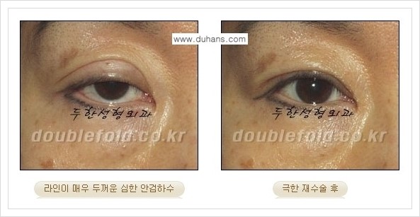 [두한성형외과 경쟁력 쌍꺼풀 재수술] - [극한의 상태에서 쌍꺼풀 재수술 안내 ②] 관련 이미지 14