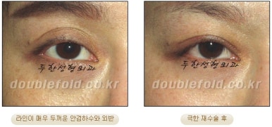 [두한성형외과 쌍수] - [재수술 실패의 원인, 재수술의 성공 요건] 관련 이미지 42