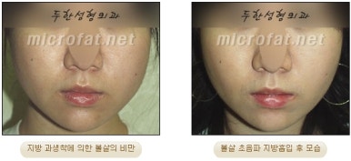 Facial Fat Liposuction at Duhan Plastic Surgery - Cheek Fat Liposuction, Jawline Liposuction, Under-Eye Fat Liposuction image 23