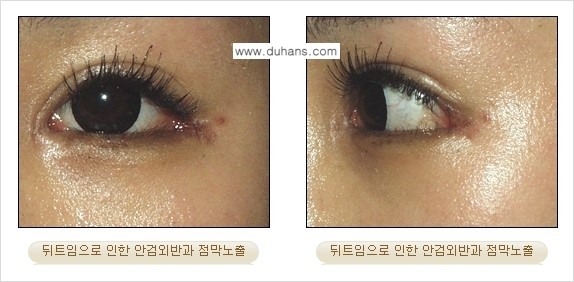 [두한성형외과 경쟁력 눈성형] - [뒤트임 수술 안내] 관련 이미지 6