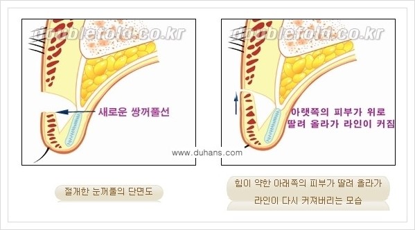 [두한성형외과 경쟁력 쌍꺼풀 재수술] - [두껍고 어색한 라인 교정하는 방법 안내 1.] 관련 이미지 10