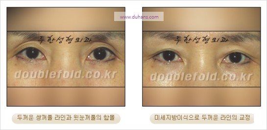[두한성형외과 경쟁력 눈성형] - [극한 재수술, 함몰된 눈꺼풀 라인교정, 안검하수(졸리운 눈매)] 관련 이미지 60