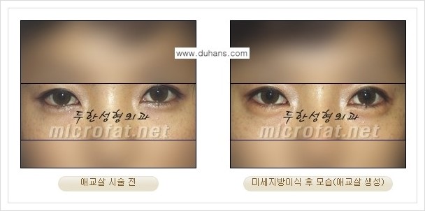 [두한성형외과 경쟁력 눈밑성형] - [눈밑 애교살 시술 안내 1.] 관련 이미지 5