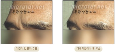 Duhan Plastic Surgery Wrinkle Improvement - Glabellar Horizontal Wrinkles, Glabellar Straight Wrinkles, Glabellar Wrinkle Surgery image 10