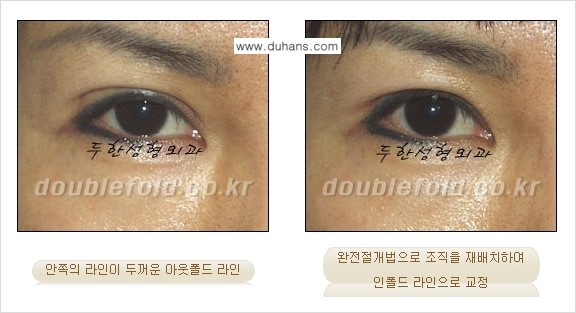 [두한성형외과] - [아웃폴드를 인폴드로 변화시키는 쌍꺼풀재수술] 관련 이미지 6