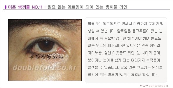 [두한성형외과 경쟁력 쌍꺼풀 재수술, 극한 눈재수술] - [Dr. 컬럼 - 재수술의 목표] 관련 이미지 14