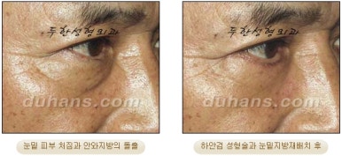 Blepharoplasty, Duhan Plastic Surgery - Upper and Lower Eyelids image 32