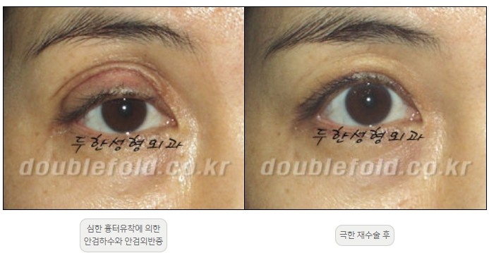 [Double Eyelid Surgery, Duhan Plastic Surgery] - [Extreme Revision Eye Surgery to Correct a Damaged Line] image 10