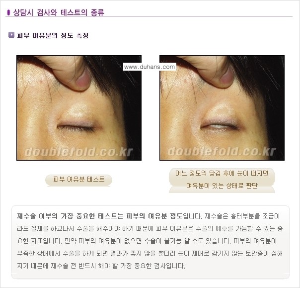 [두한성형외과 경쟁력 쌍꺼풀 재수술] - [쌍꺼풀 재수술에 대한 최선의 대안 제시] 관련 이미지 5