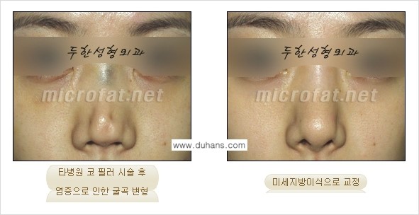 ​[두한성형외과의 No.1 경쟁력 미세(자가)지방이식] - [코높힘 미세(자가)지방이식 ②] 관련 이미지 16