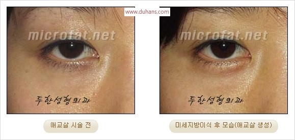 ​﻿[두한성형외과 경쟁력 지방이식] - [눈밑 애교살 시술을 위한 미세지방이식] 관련 이미지 11