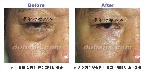 [두한성형외과 경쟁력 동안성형 리더] - ​[미간주름, 이마주름, 안검성형, 이마거상술, 눈썹거상술] 관련 이미지 73