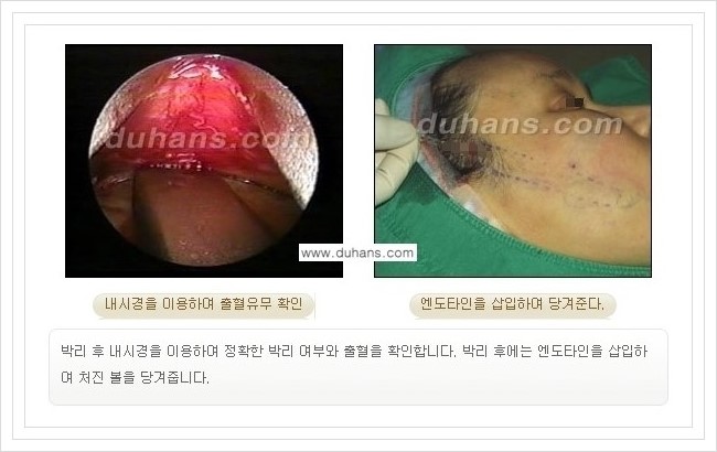 [두한성형외과 경쟁력 주름성형] - [회복과 일상으로의 복귀가 빠른 주름교정 엔도타인 리프팅] 관련 이미지 16