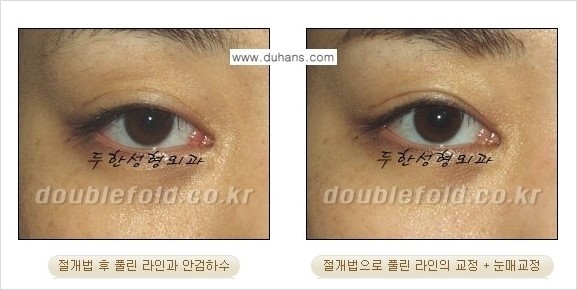 [두한성형외과 경쟁력 눈성형] - [풀린 쌍꺼풀 라인 재수술의 여러 가지 방법 안내] 관련 이미지 2
