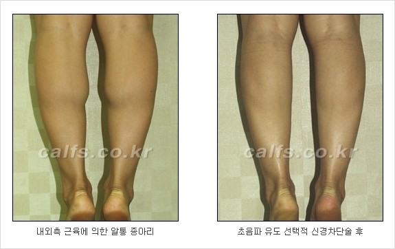 [두한성형외과 경쟁력 종아리성형] - [초음파 유도 선택적 신경차단술 안내 ④] 관련 이미지 7