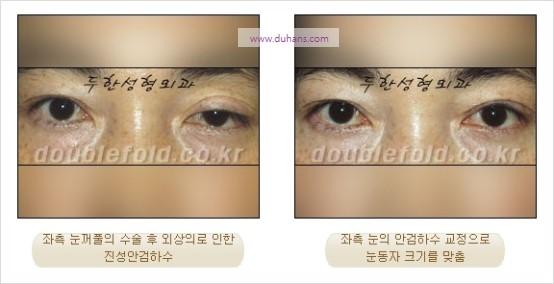 [두한성형외과 경쟁력 눈성형] - [극한 재수술, 함몰된 눈꺼풀 라인교정, 안검하수(졸리운 눈매)] 관련 이미지 86