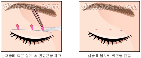 [Duhan Plastic Surgery Double Eyelid Surgery] - [Double Eyelid Guide] image 3