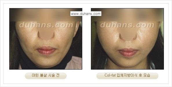 [두한성형외과 경쟁력 미세지방이식] - [지방이식 특허 Col-fat 미세지방이식 성공사례 안내] 관련 이미지 13